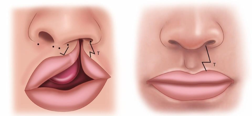 Cleft Lip and Palate