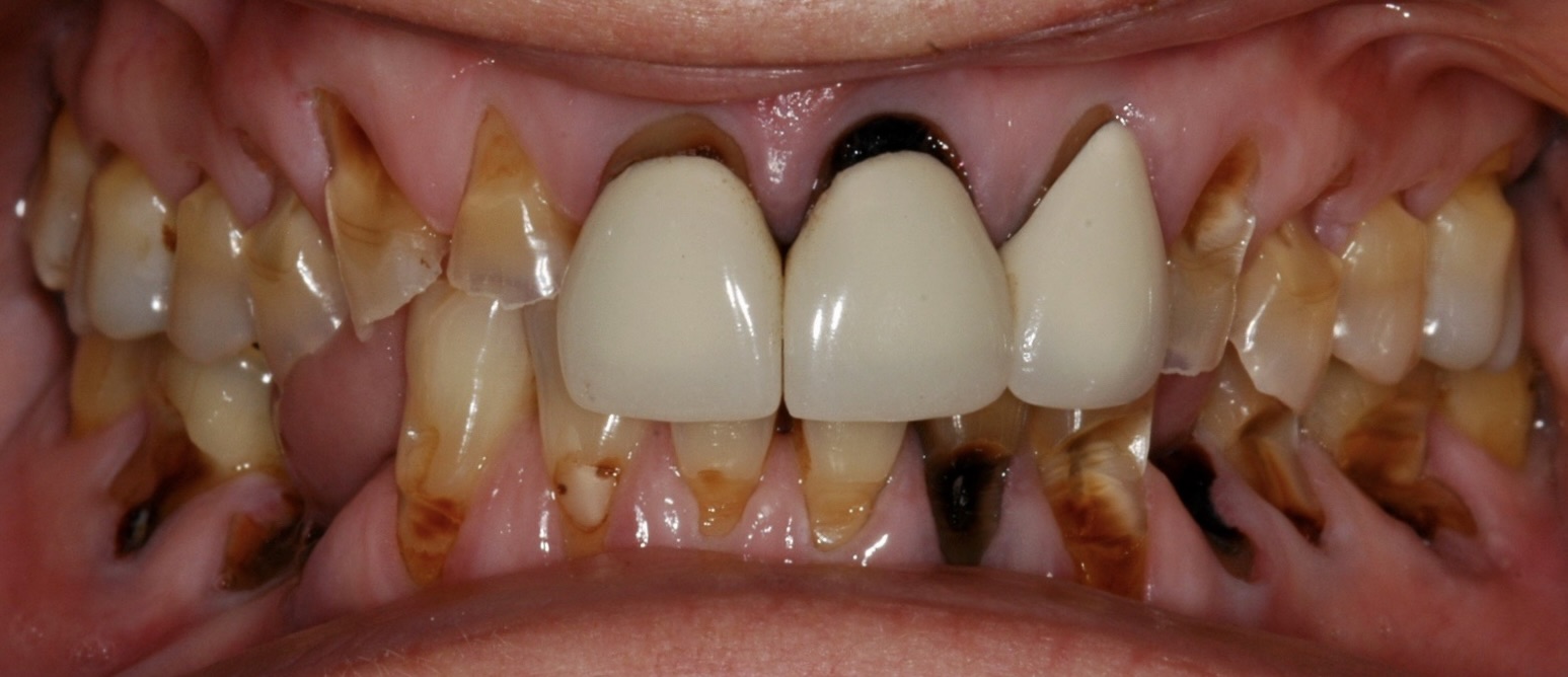 A Full-Mouth Reconstruction To Replace Decayed and Broken Teeth