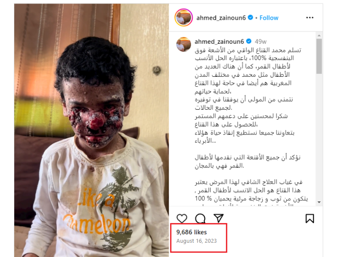 طفل مصاب بجفاف الجلد في المغرب