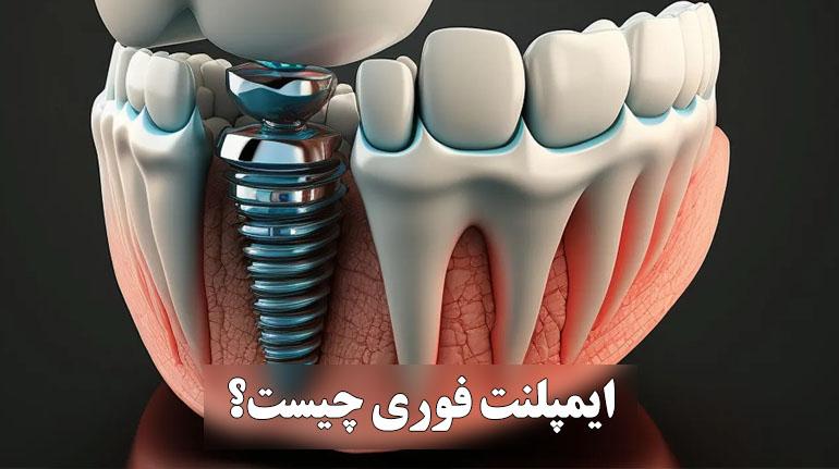 ایمپلنت فوری چیست + بررسی انواع، مزایا و قیمت