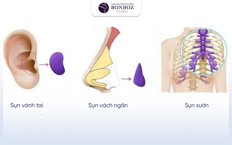  Nâng mũi cấu trúc toàn diện sụn tự thân