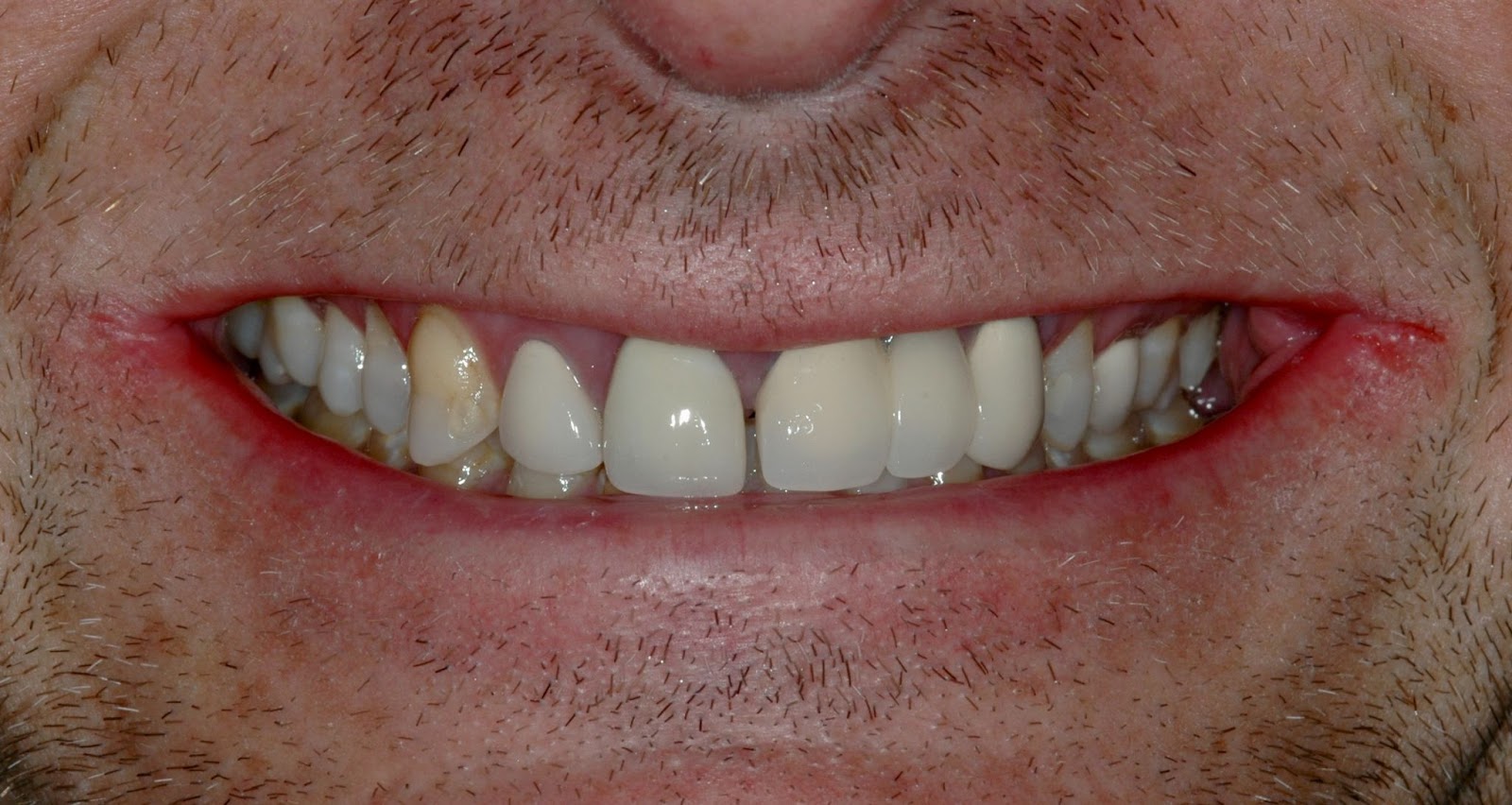 How A Smile Makeover Can Transform Your Aesthetics And Boost Your Confidence