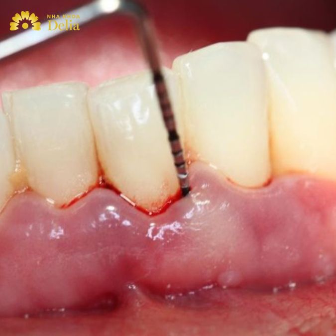 Giải pháp xử lý lấy cao răng xong bị chảy máu liên tục