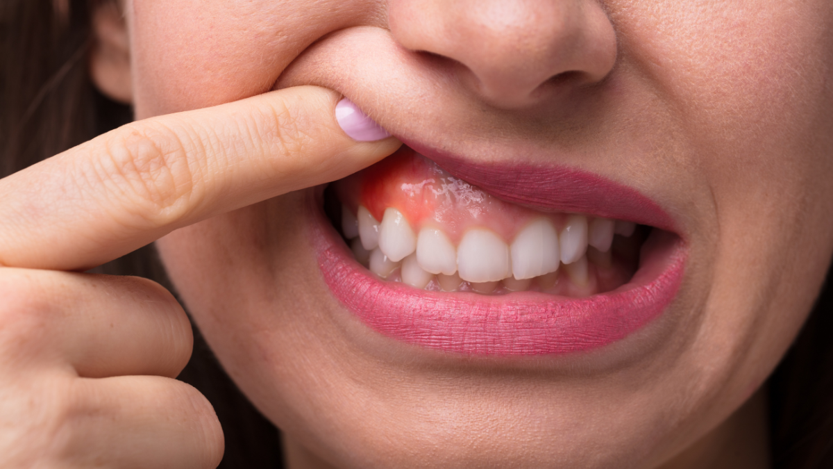 Redness Is A Sign Of Gum Damage