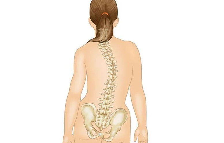 Tanda Terkena Skoliosis Pinggul Tidak Sejajar