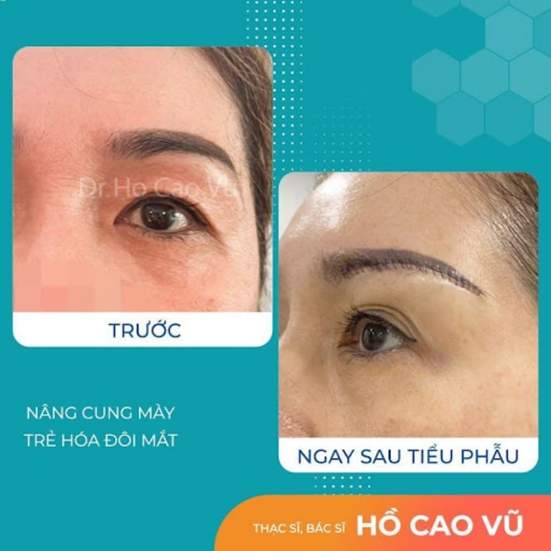 Treo chân mày ở đâu đẹp? 3 tiêu chí quan trọng chọn địa chỉ nâng cung mày uy tín