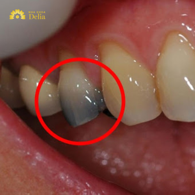 Khi nào cần lấy tủy răng: răng đổi màu