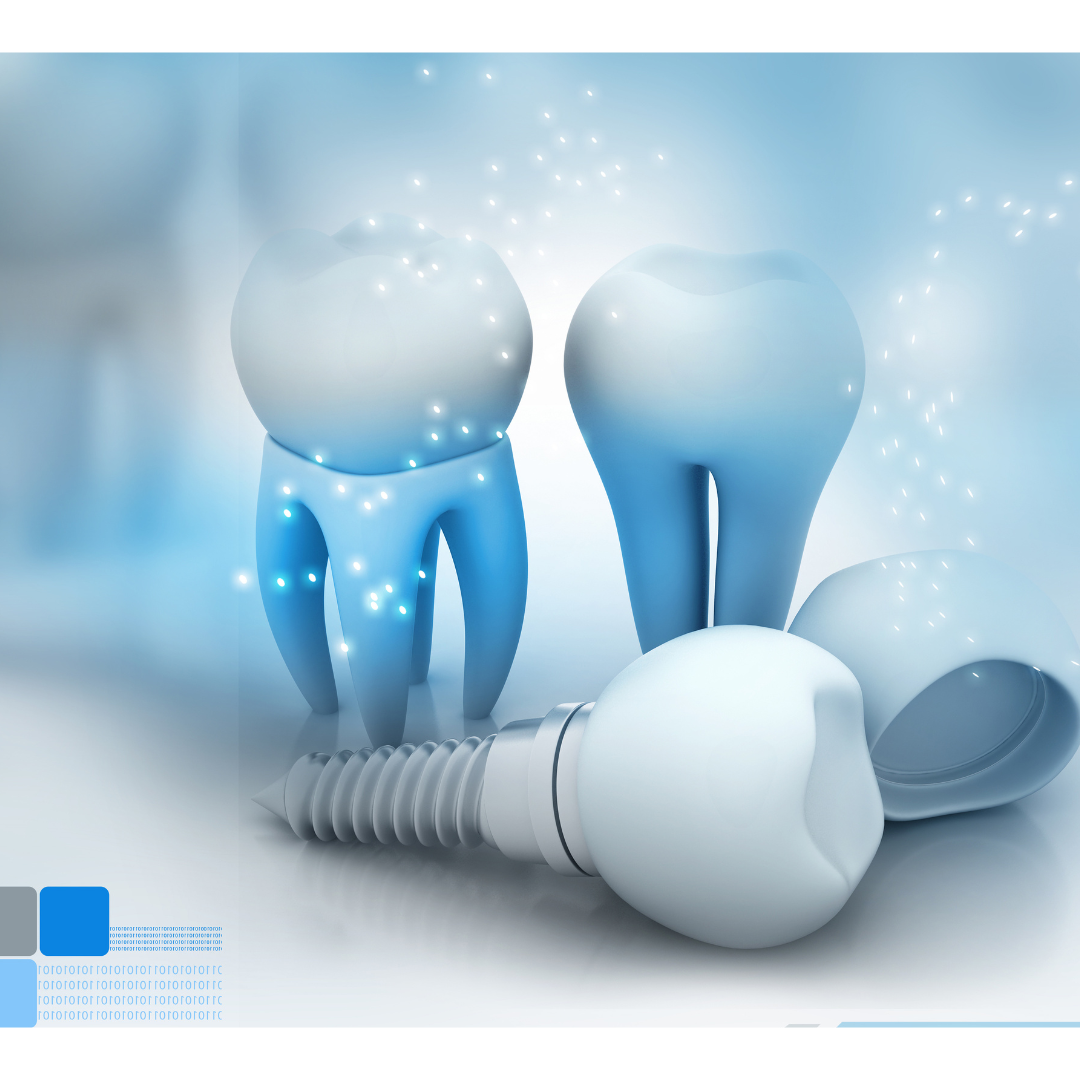 How Much Is a Full Set of Dental Implants