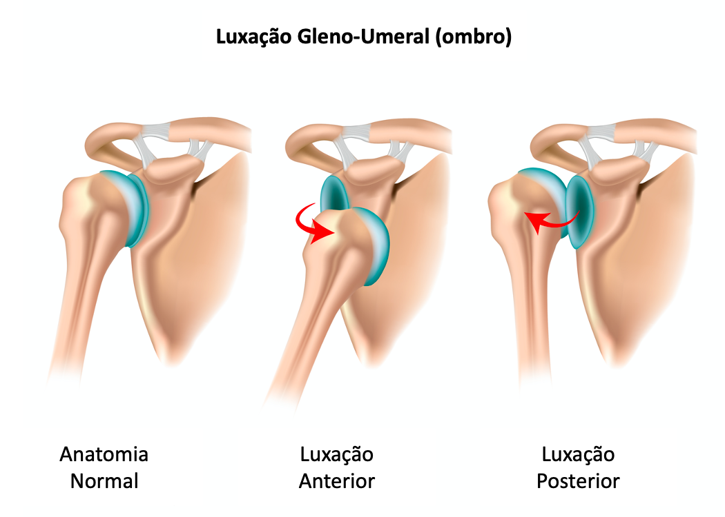 A luxação do ombro é uma lesão dolorosa e incapacitante que ocorre quando a cabeça do úmero, o osso do braço, sai da cavidade glenoide, a parte da escápula que forma a articulação do ombro. Essa articulação, conhecida por sua ampla gama de movimentos, é também uma das mais instáveis do corpo humano, tornando-a suscetível a luxações.