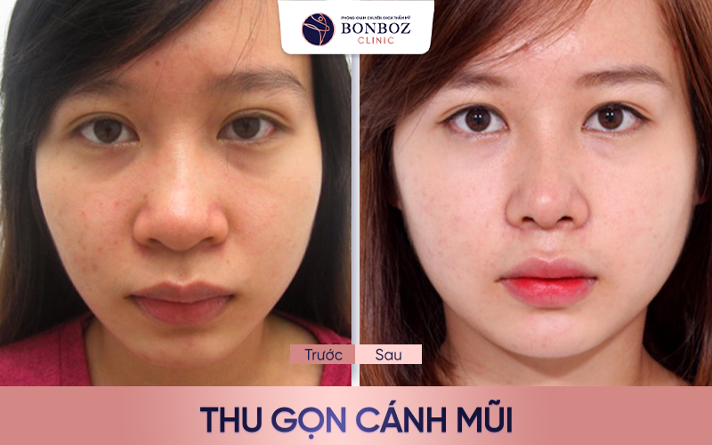 Kết quả phẫu thuật thu gọn cánh mũi