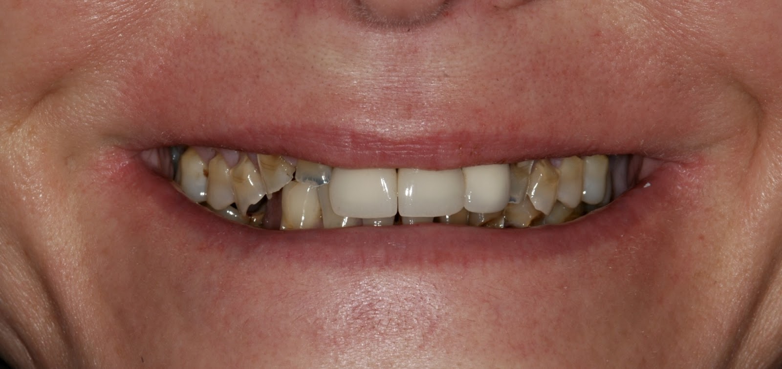 A Full-Mouth Reconstruction To Replace Decayed and Broken Teeth