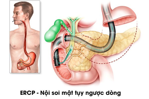 Nội soi mật tụy ngược dòng vừa giúp chẩn đoán, vừa giúp điều trị sỏi ống mật chủ