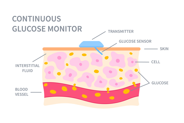 Illustration of the transmitter and glucose sensor of a continuous glucose monitor 