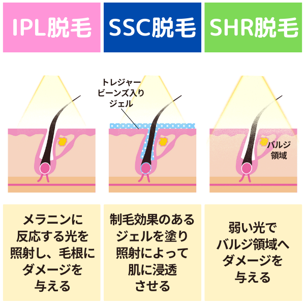 業務用脱毛機の種類図解