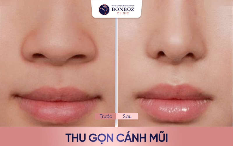 Thu gọn cánh mũi thon gọn, hài hòa vói khuôn mặt