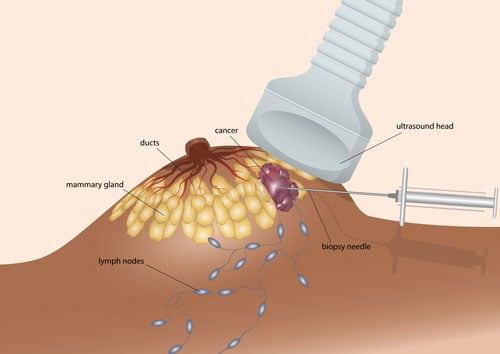 Sinh thiết cắt bỏ (Excision Biopsy)