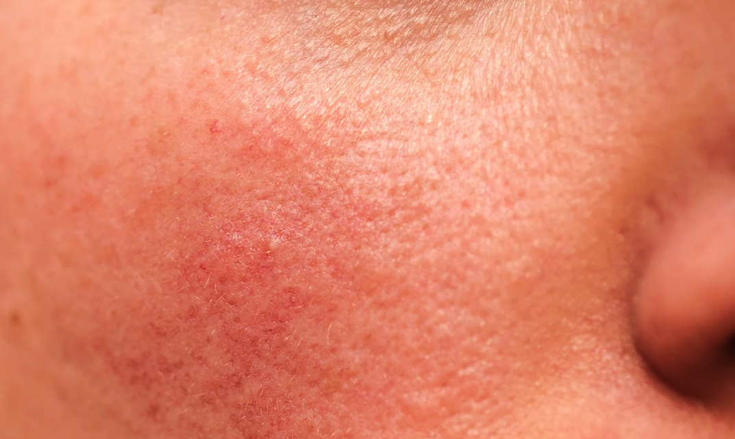 Effects of the sun on the skin