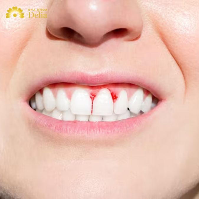 hảy máu liên tục sau khi lấy cao răng, kèm theo sưng viêm lợi, hôi miệng là dấu hiệu cảnh báo vấn đề nghiêm trọng