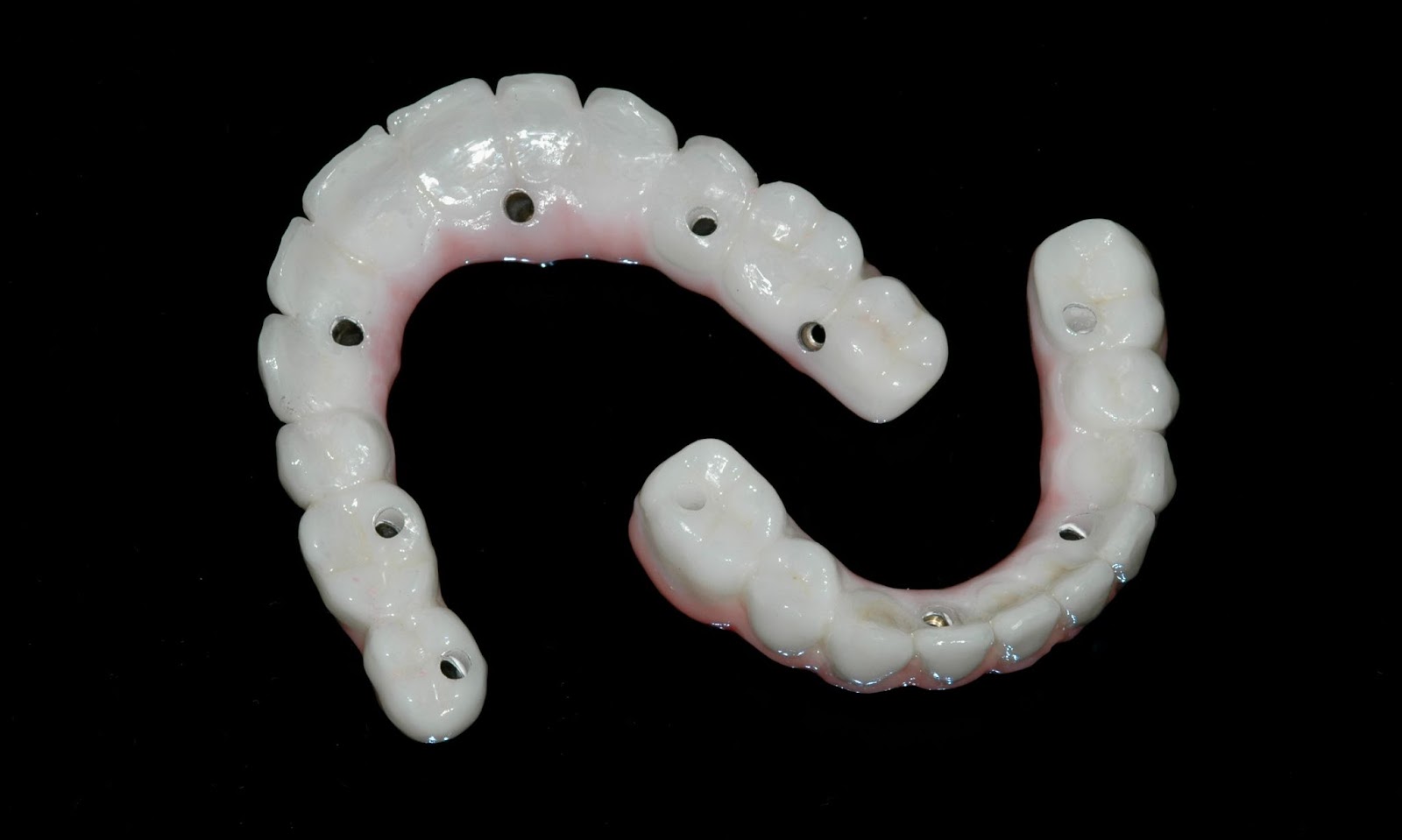 Upper and Lower Implant Bridges