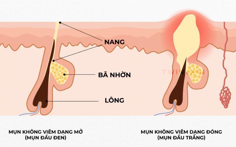 mụn đầu đen và mụn đầu trắng