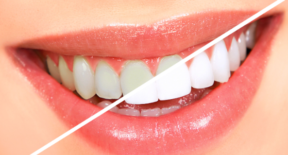 teeth bleaching