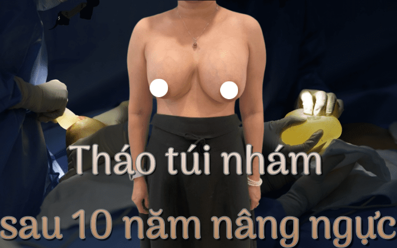 Tháo túi ngực cho khách đã đặt 10 năm: Túi bị gấp, vỡ túi, bao xơ