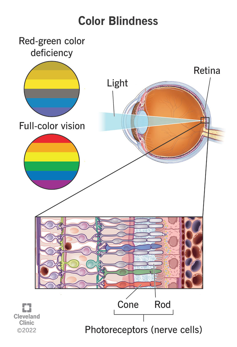 If you have color blindness, some of your cones are missing or don't work properly. (Source: https://my.clevelandclinic.org/health/diseases/11604-color-blindness)