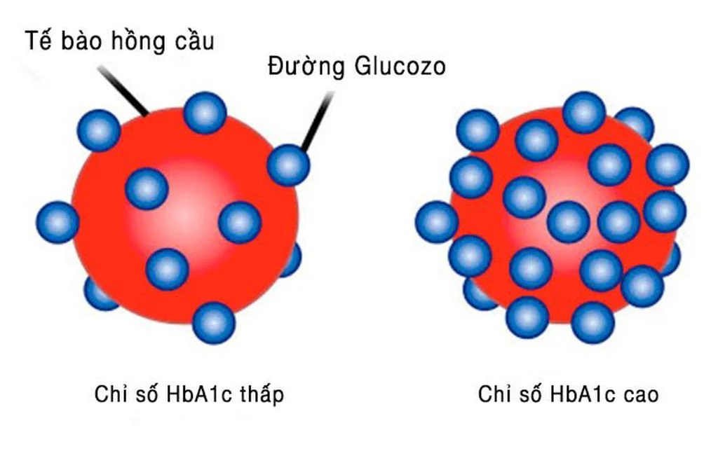 Chỉ số HbA1c cao khi tế bào hồng cầu mang nhiều đường glucozo