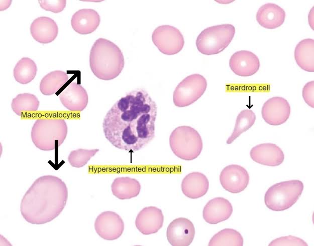 Megaloblastic Anemia