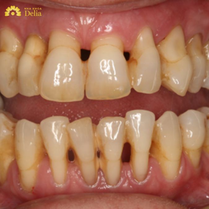 Các nguyên nhân thông thường dẫn đến răng thưa 