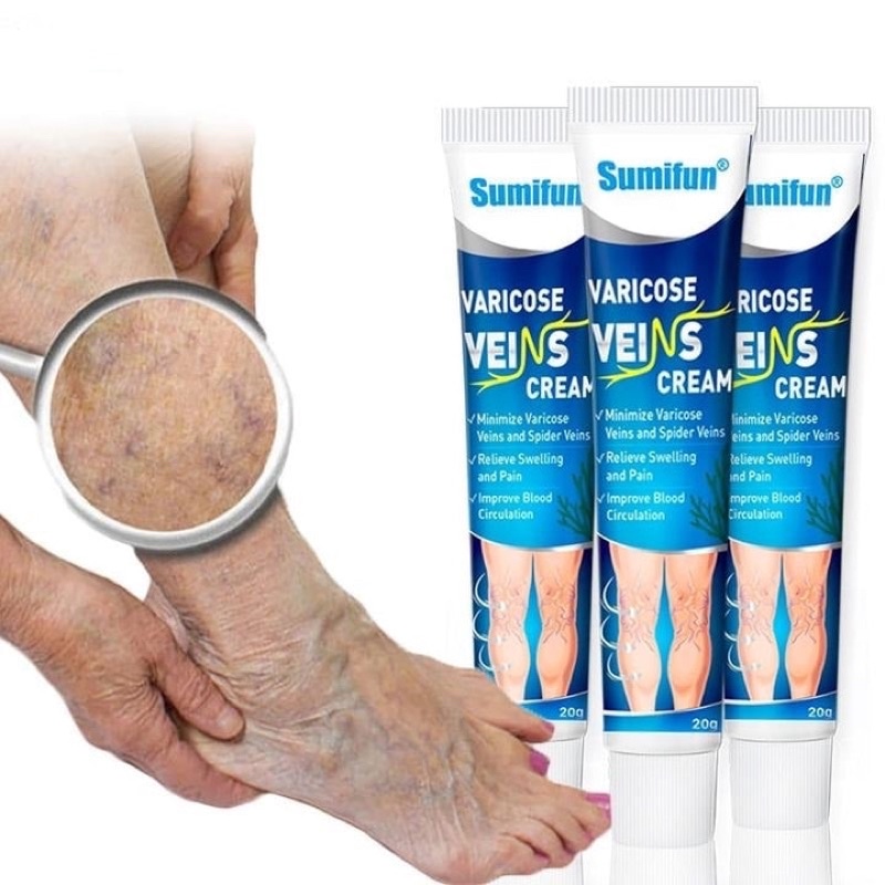 Varicose Veins Creme  Varicose Veins Cream  Varicose  Creme Para Varise  Creme Para Varises  Creme Para Varizes  Creme Para Varize