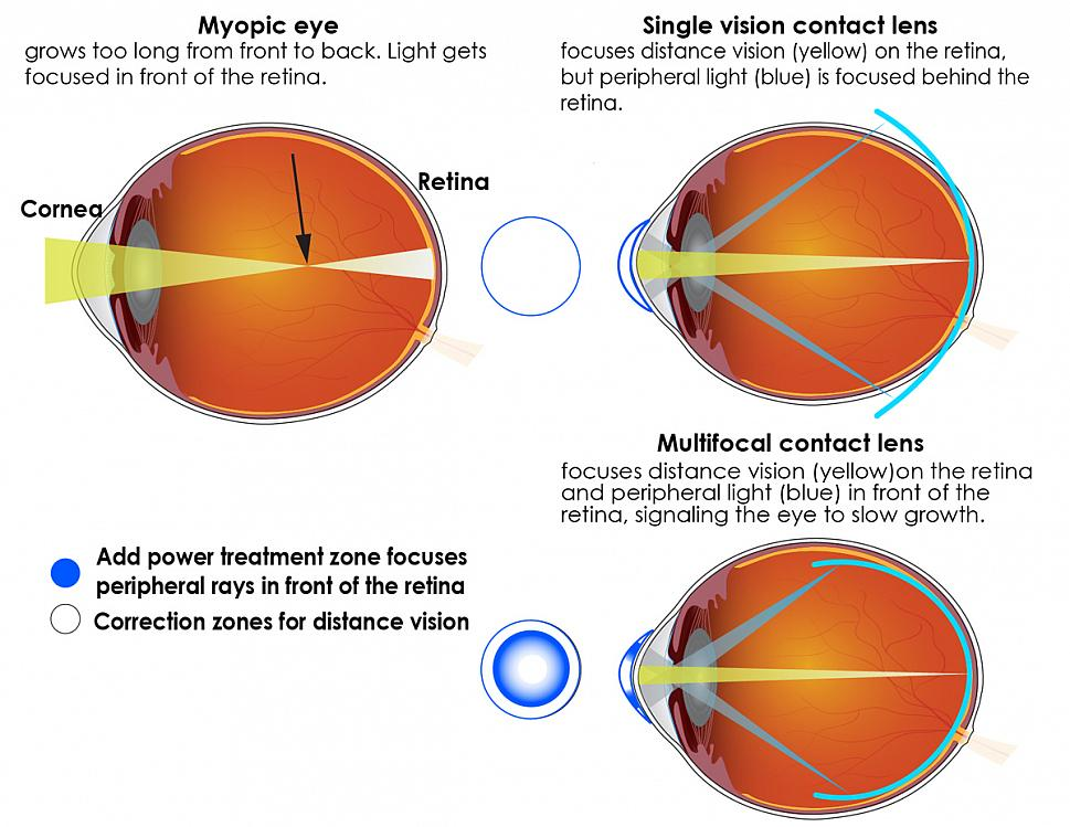 The center portion of the lens corrects nearsightedness so that distance vision is clear, and it focuses light directly on the retina. The outer portion of the lens adds focusing power to bring the peripheral light rays into focus in front of the retina. (Source: https://www.nih.gov/news-events/news-releases/multifocal-contact-lenses-slow-myopia-progression-children)