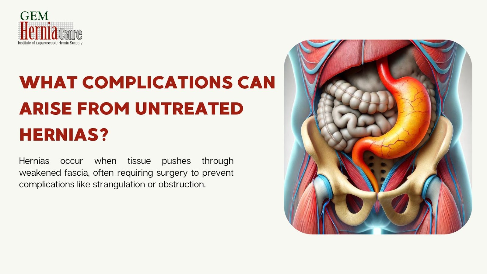 What Complications Can Arise from Untreated Hernias