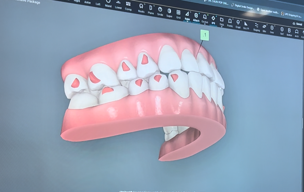 A diagram of the attachments places on the teeth