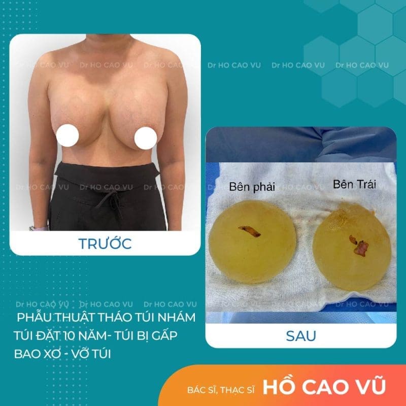 Tháo túi ngực cho khách đã đặt 10 năm: Túi bị gấp, vỡ túi, bao xơ 