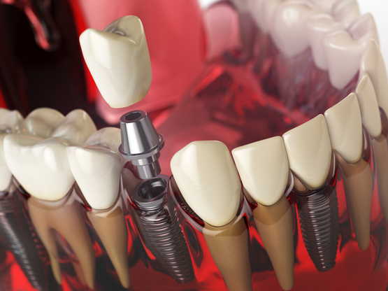 dental implants