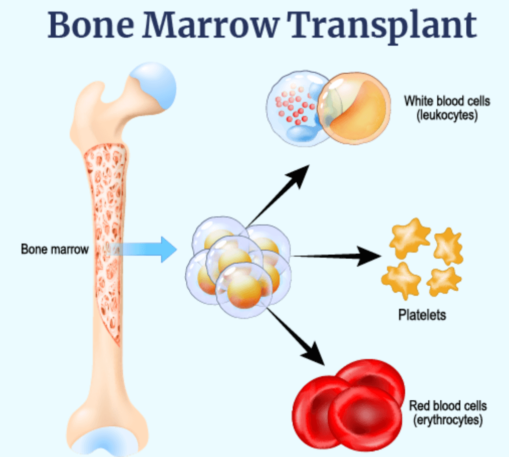 Bone marrow transplant (BMT)