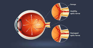 optic nerve atrophy curable by stem cell treatment