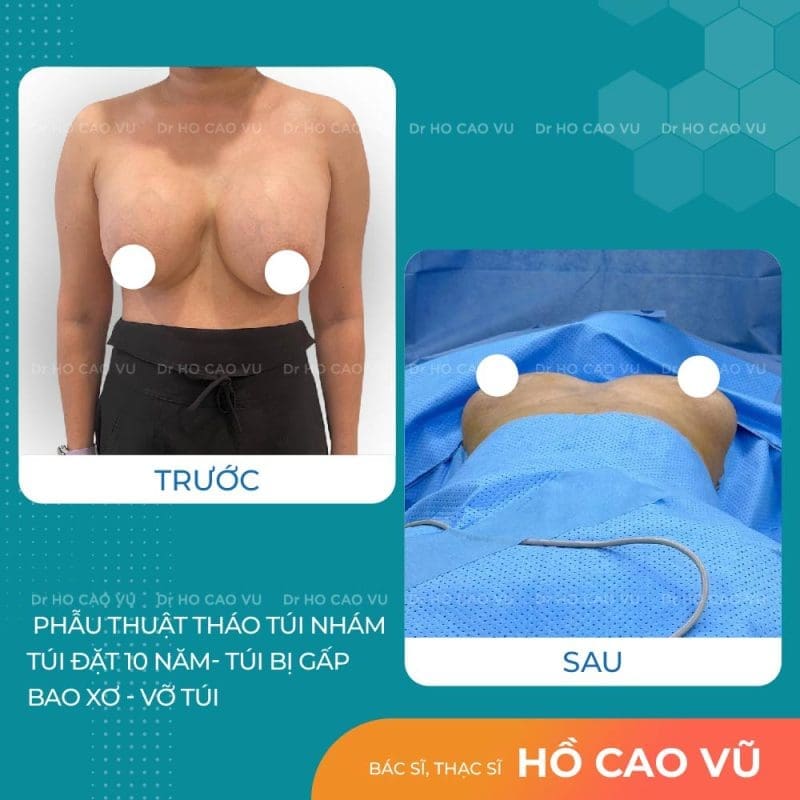 Tháo túi ngực cho khách đã đặt 10 năm: Túi bị gấp, vỡ túi, bao xơ 