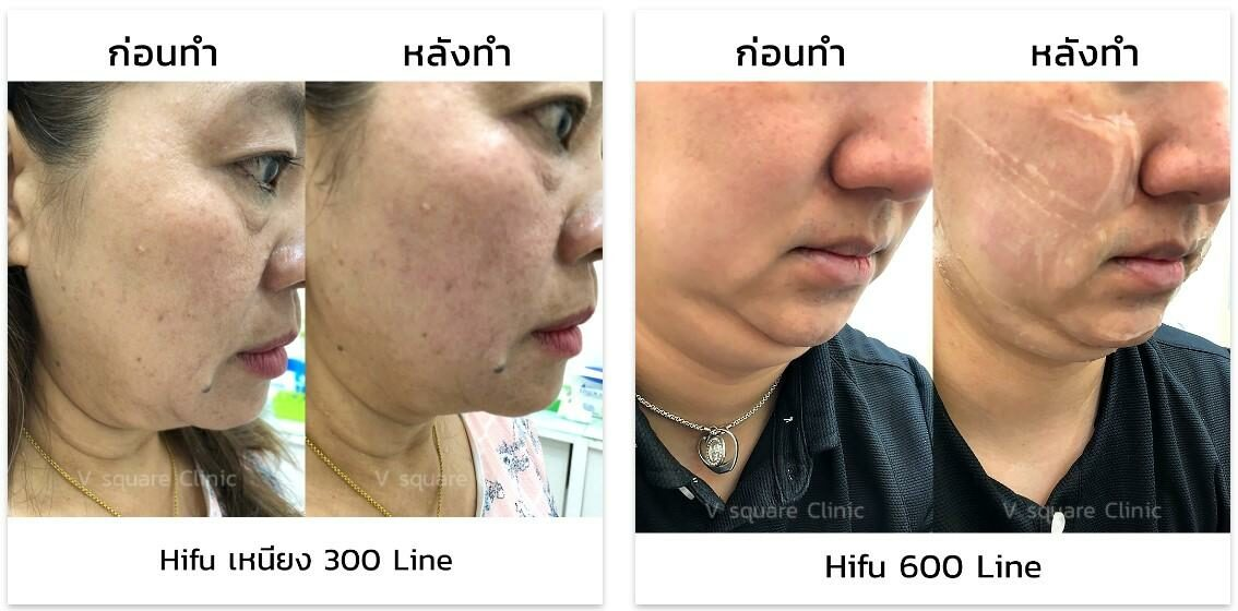 รีวิว Hifu เหนียง 