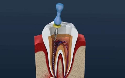 Root Canal Treatment (RCT) - Shree Dental Speciality Hospital, Kalyan