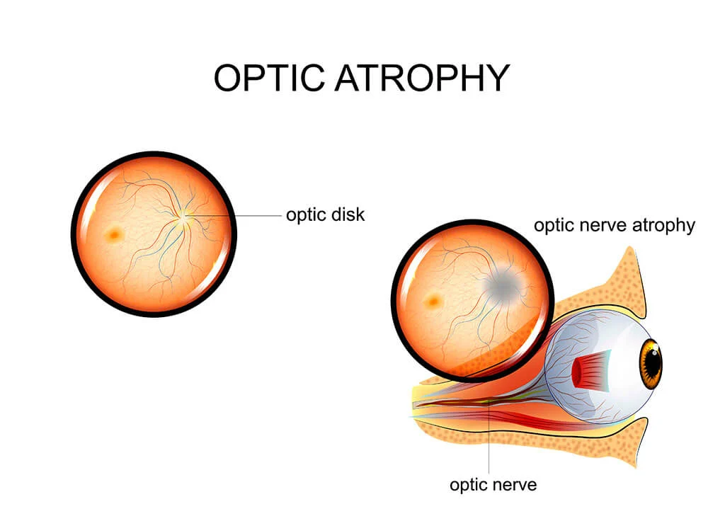 optic nerve atrophy stem cell treatment