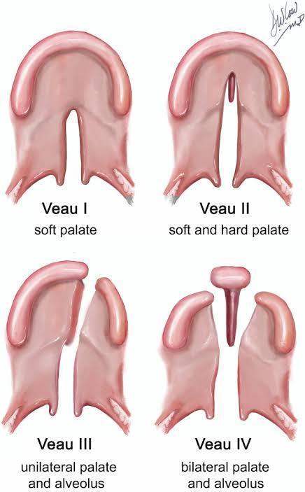 Cleft Lip and Palate