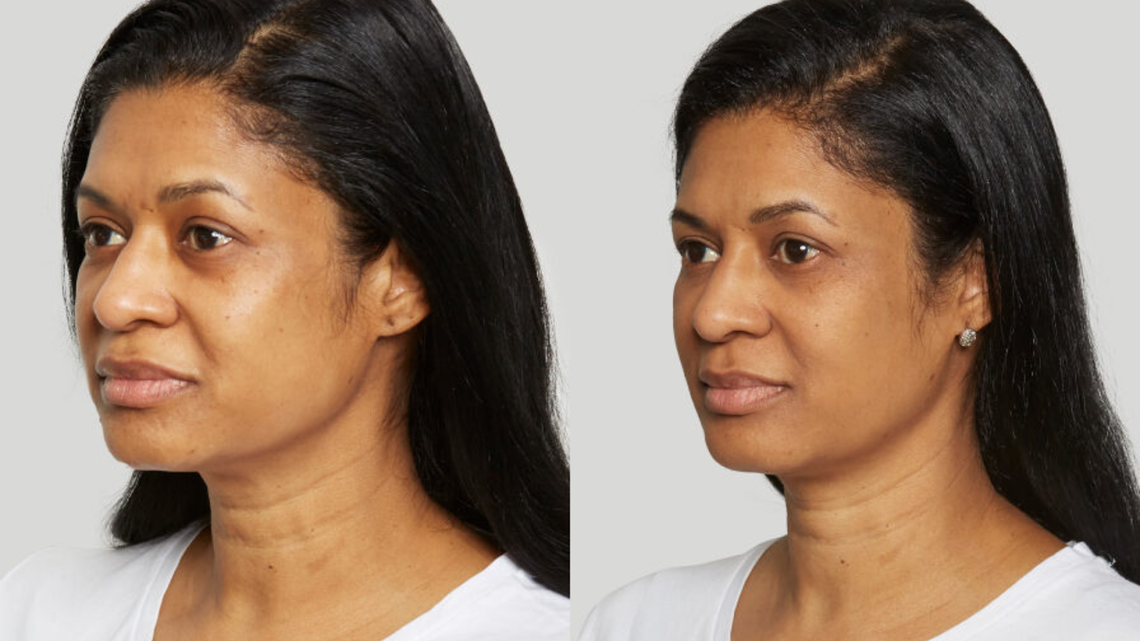 Before and after facial treatment.