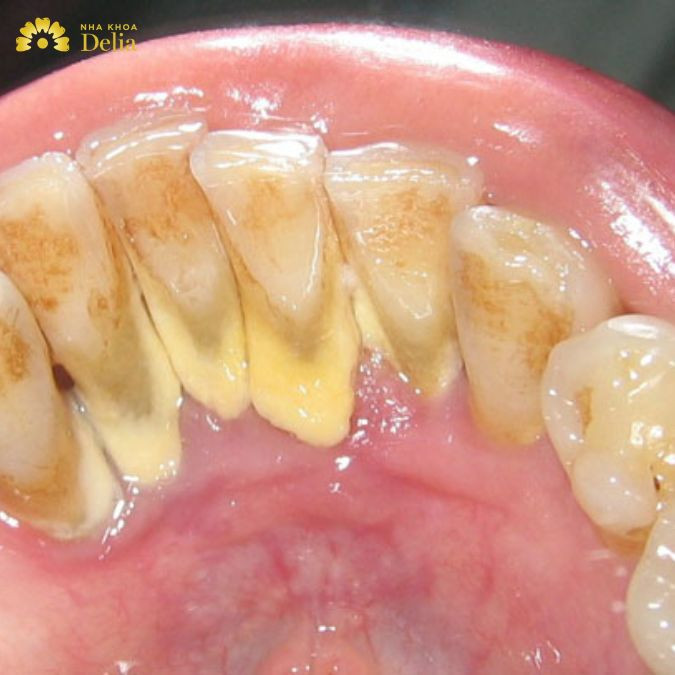 Cạo vôi răng chỉ loại bỏ mảng bám và vôi răng, không ảnh hưởng đến men hay ngà răng