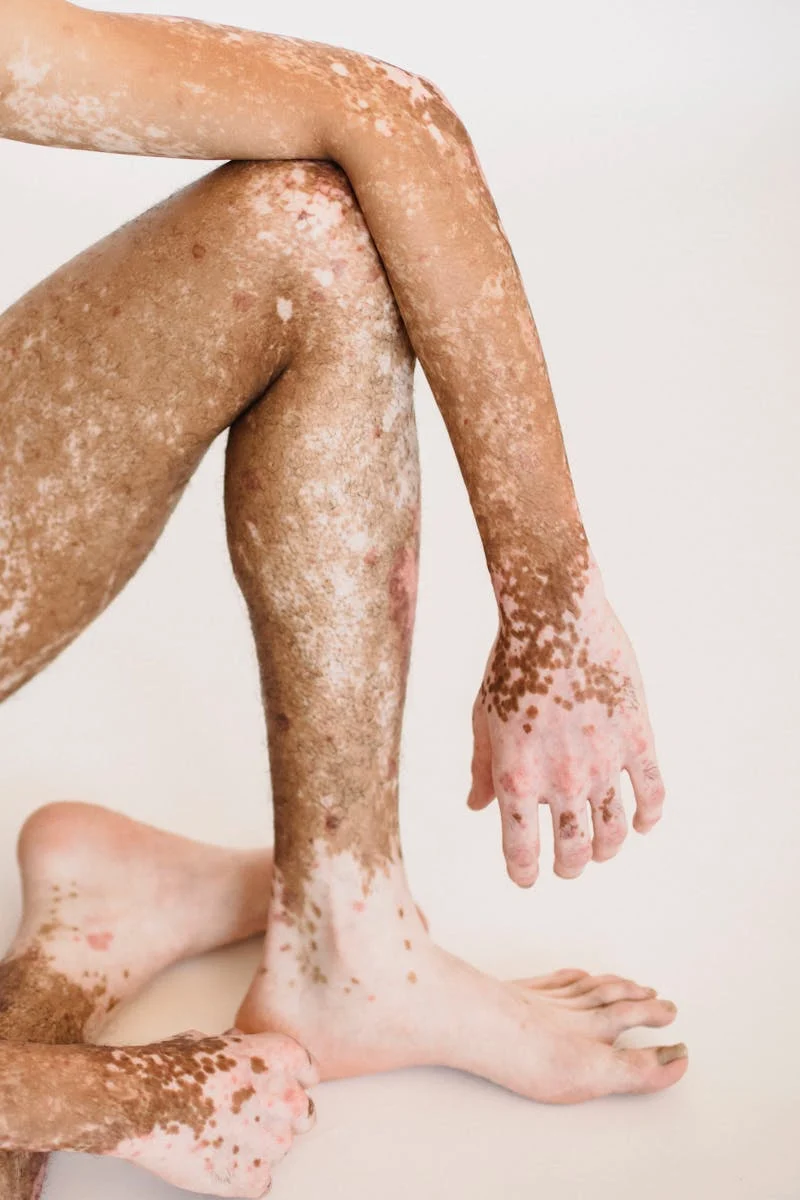 Vitiligo on arms and legs.