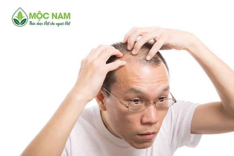 Hói tóc khiến nhiều nam giới trông già trước tuổi