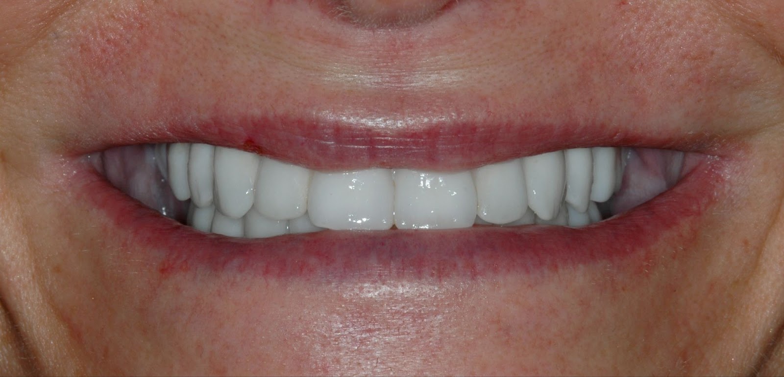 Upper and Lower Implant Bridges