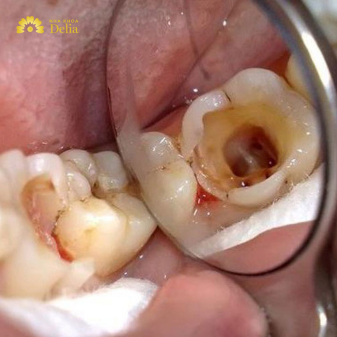 Sâu răng là một trong những nguyên nhân phổ biến nhất gây viêm tủy răng