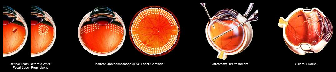retinal detachment overview, what is it and what does it look like